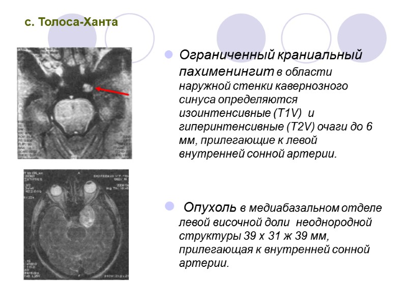 с. Толоса-Ханта Ограниченный краниальный пахименингит в области наружной стенки кавернозного синуса определяются изоинтенсивные (T1V)
